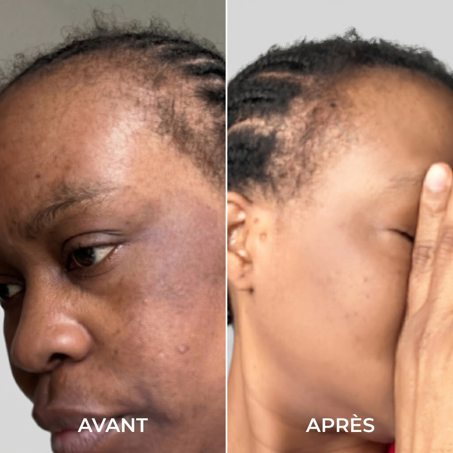 Retrouvez une peau plus uniforme, plus lumineuse et une confiance retrouvée en 21 jours